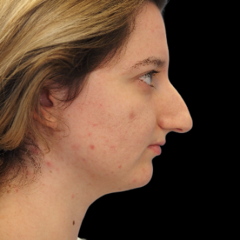 ultrasonic-rhinoplasty-before